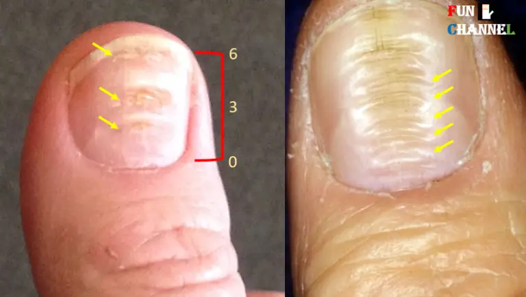 what-causes-ridges-in-your-fingernails-medicalrecords