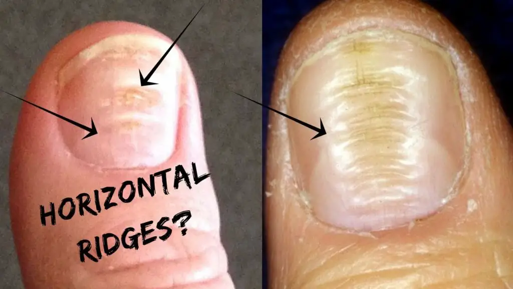 Horizontal Ridges And Beau's Lines On Your Nails?-Palmistry