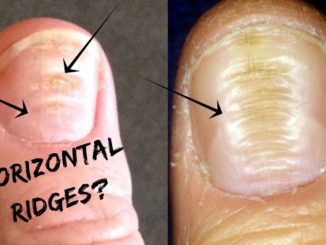 Horizontal Ridges on nails