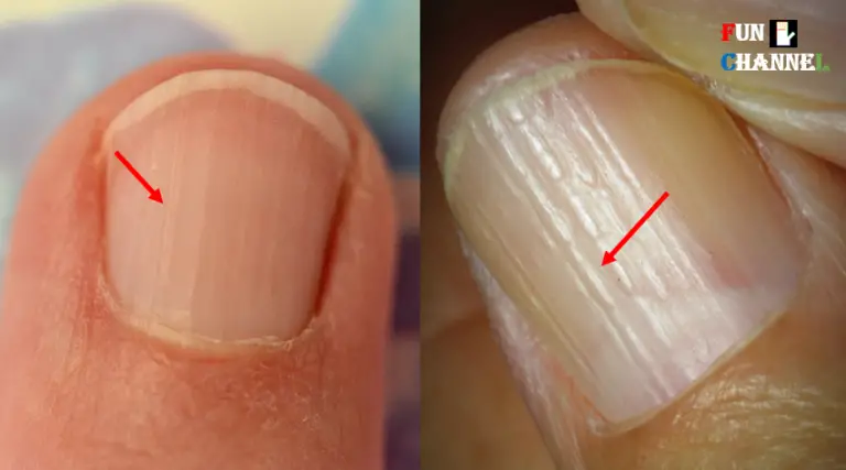 Do You Have These Vertical Ridges On Your Nails   13 768x427 