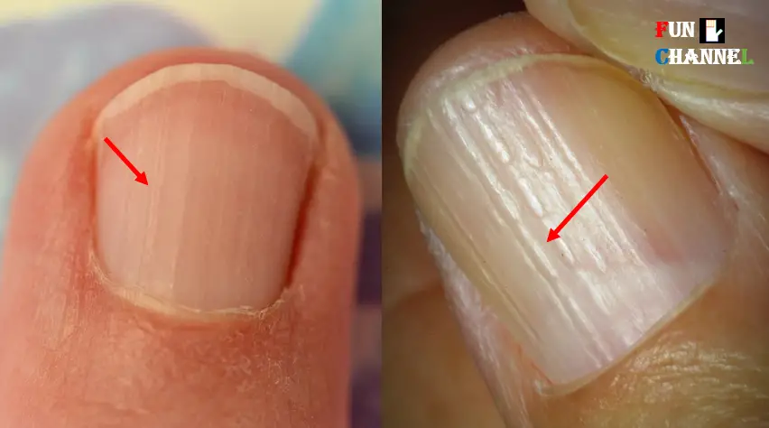 what-do-vertical-ridges-on-nails-mean-causes-and-prevention