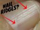 vertical nail ridges