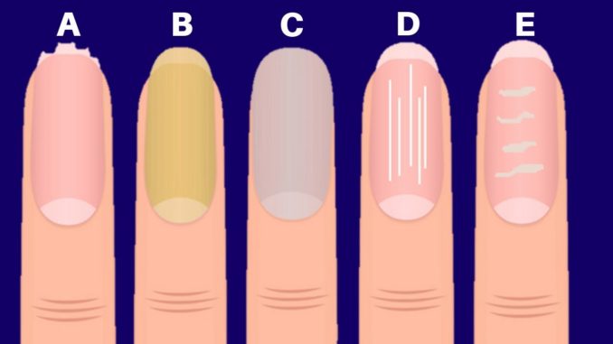 nails tells a lot about your health nails tells a lot about your health