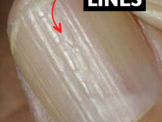 vertical lines on nails