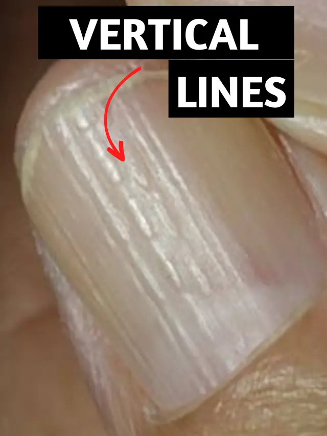 Vertical Lines On Nails And Their Causes Fun Channel