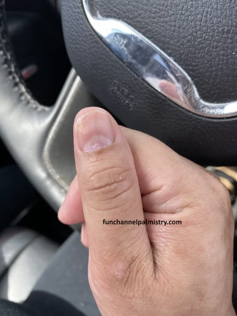 psoriasis symptoms nails in palmistry